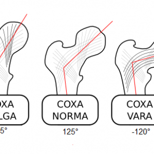 Coxa-valga-norma-vara-000